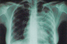 На Европу надвигается эпидемия туберкулеза